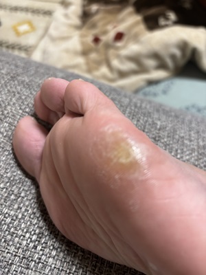 足にできたタコ