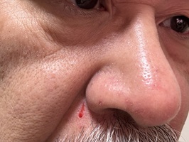 鼻の斜め下に切り傷